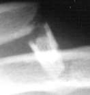 Clavical xray1